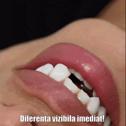 Proteze Dentare Reglabile